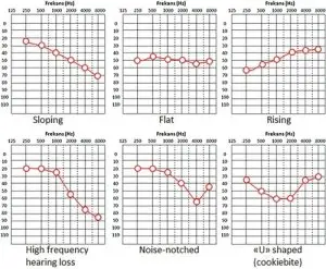 different types of audiograms to understand hearing loss types