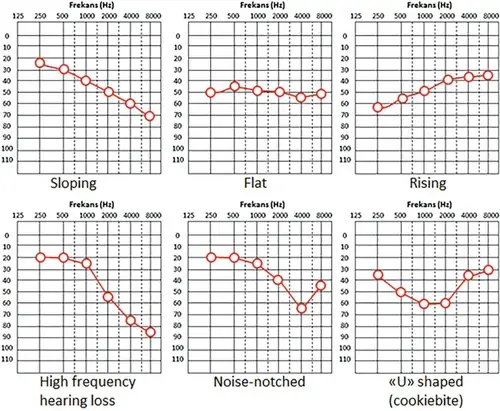 different types of audiograms to understand hearing loss types
